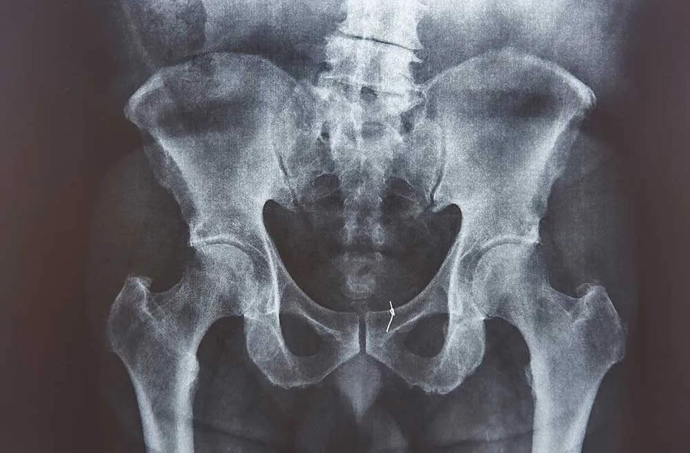 Hip Osteoarthritis